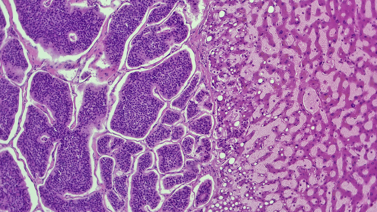 Surprise Sea of Carcinoid Cells
