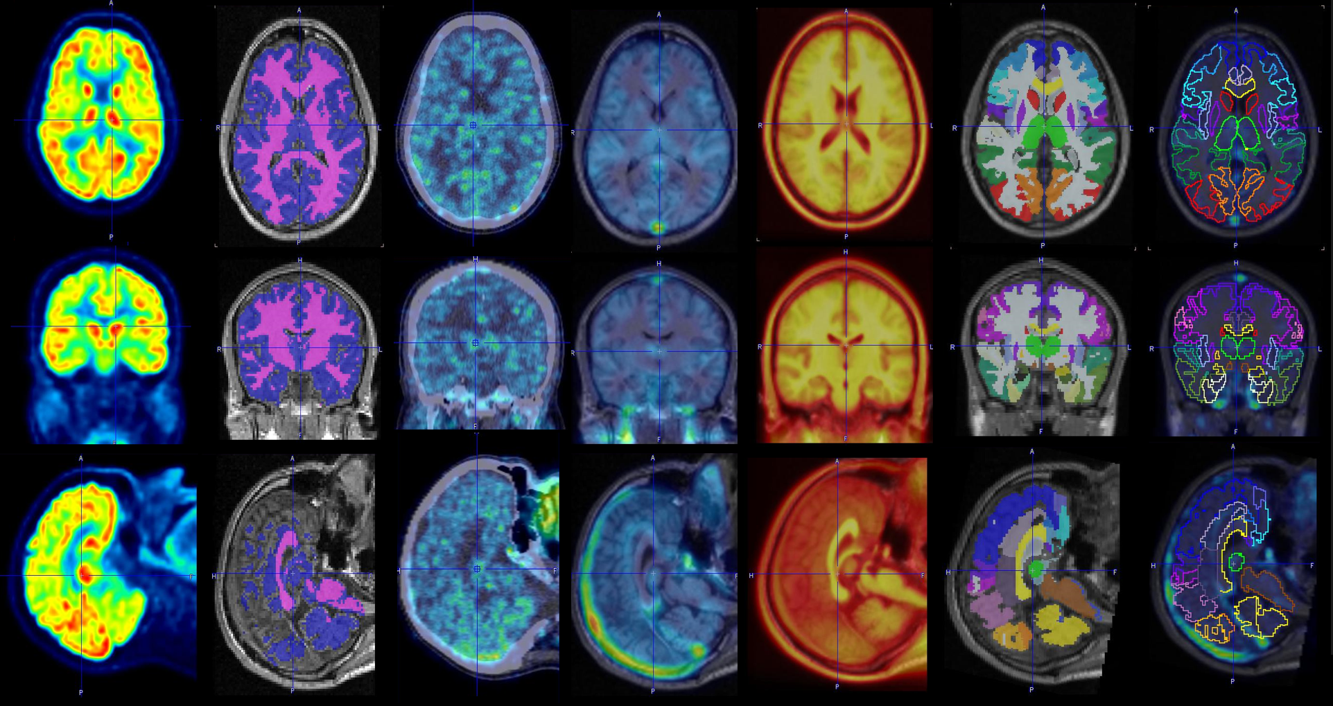 Mind's Mosaic: Brain Segmentation